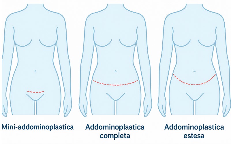 tipi di addominoplastica
