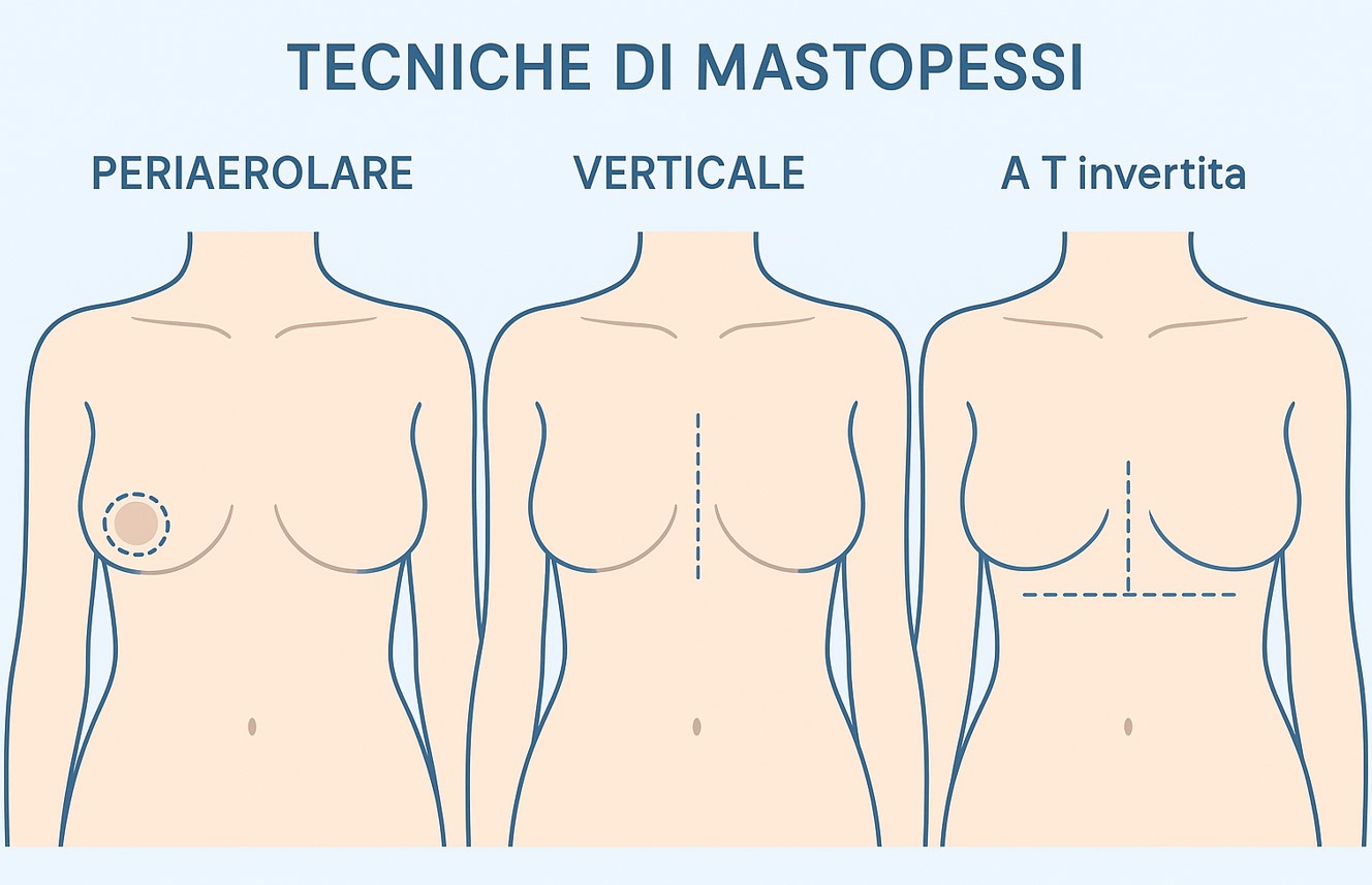 mastopessi tipologie